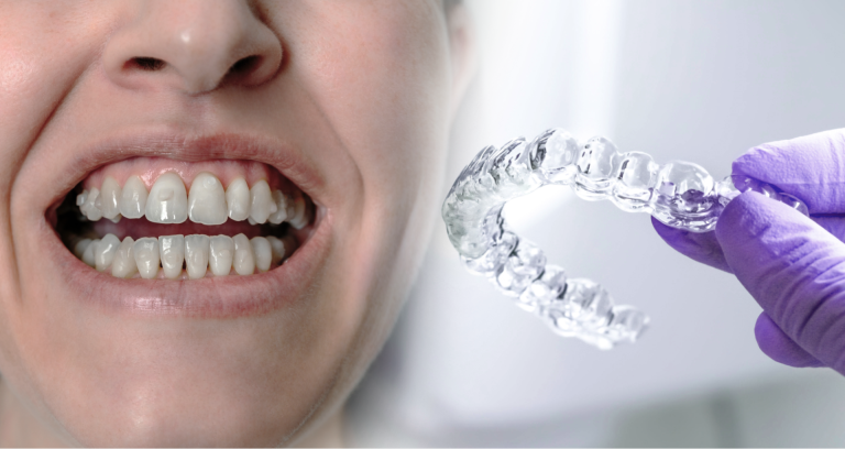 Invisalign vs. Traditional Braces: Which is Best for You in London?