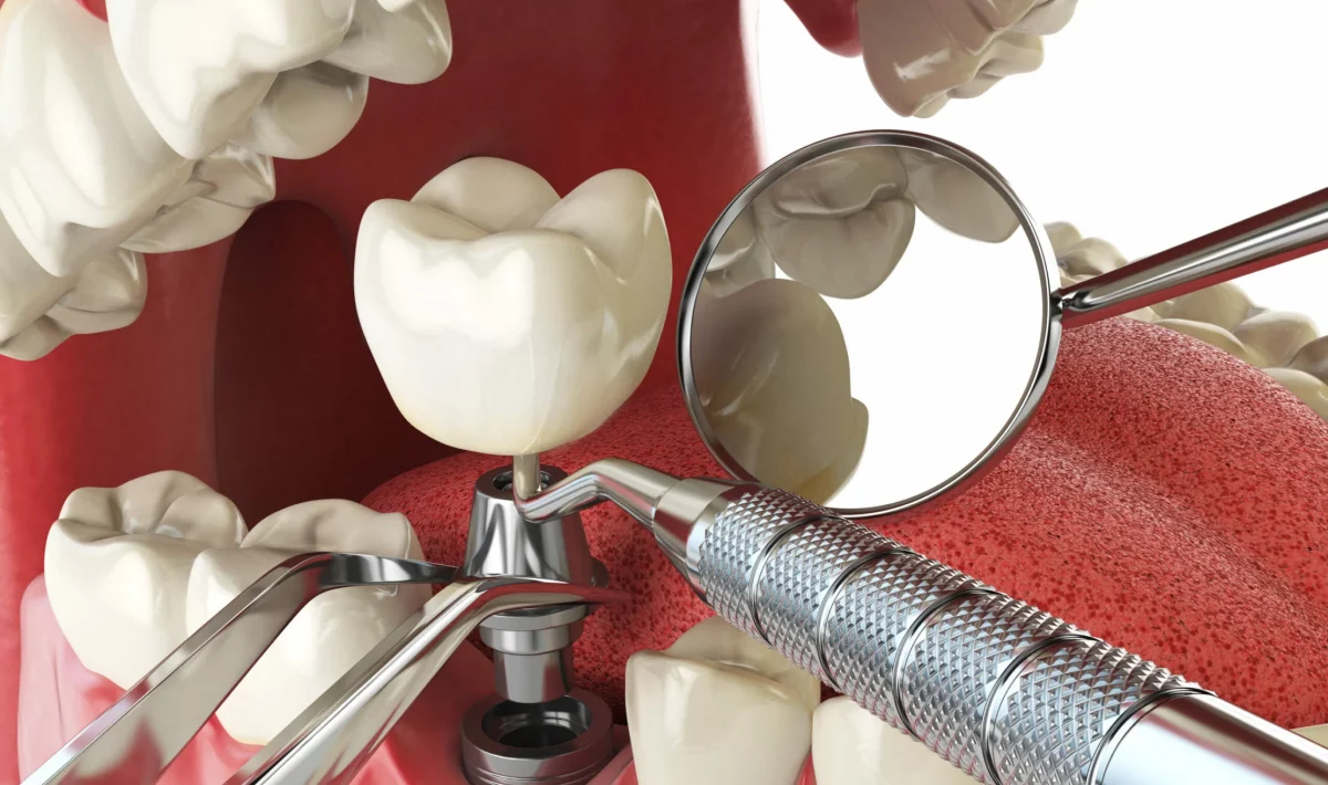 Dental Implants